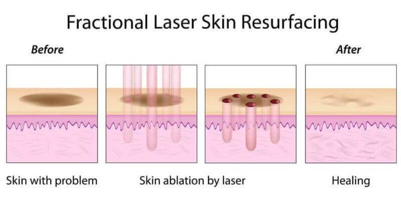 terapi laser pada wajah