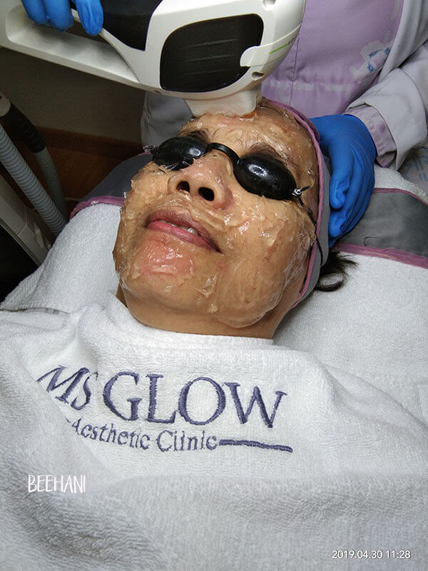 terapi laser pada wajah di klinik ms glow